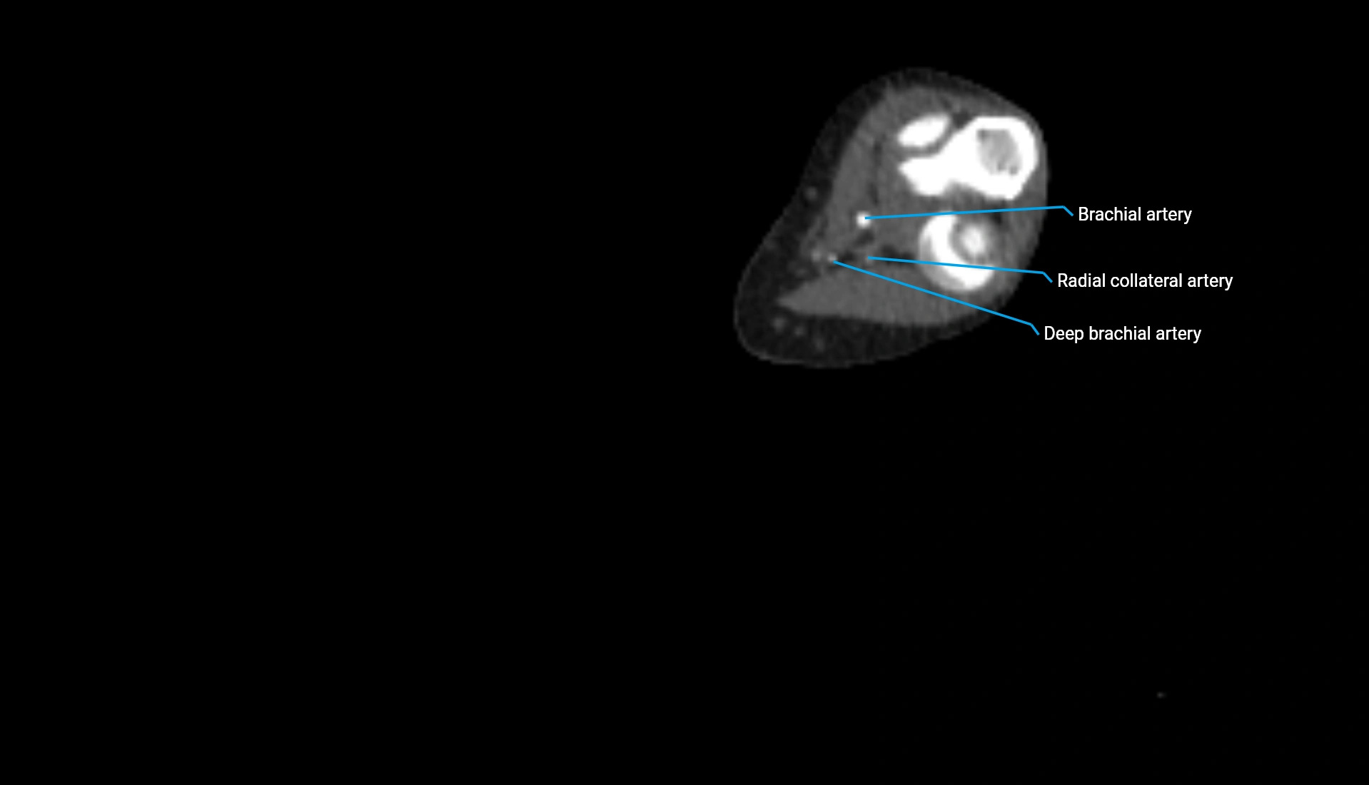 CTA upper limb axial cross sectional anatomy labelled image 184 (2).webp